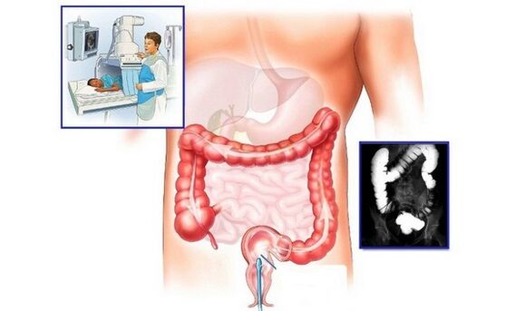 Radiographie du gros intestin avec contraste pour le diagnostic des hémorroïdes